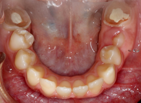 Initial lower occlusal intraoral photograph
