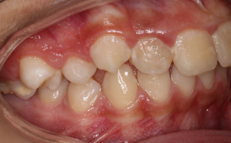 Initial right lateral intraoral photograph