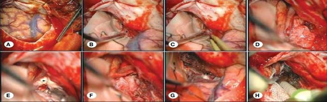 After unilateral craniotomy,A: the dura is opened; B: The tumor (asterisk) and right olfactory nerve (pointed arrow) are seen; C: After devascularization and incision from the frontobasal dura; D: Tumor excision begins; E: When we reach the falx (arrowhead), it is incised and F: The contralateral tumor is excised; G: The basal dura is cauterized; H: and the right optic nerve is seen (black arrow).