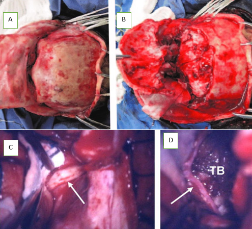 After bilateralFrontal craniotomy reaching the subfrontal area, the dura is opened (A)&(B), devascularization and excision of the tumor after release of olfactory nerve(C)i. (D) After excision and cauterization of tumor bed.