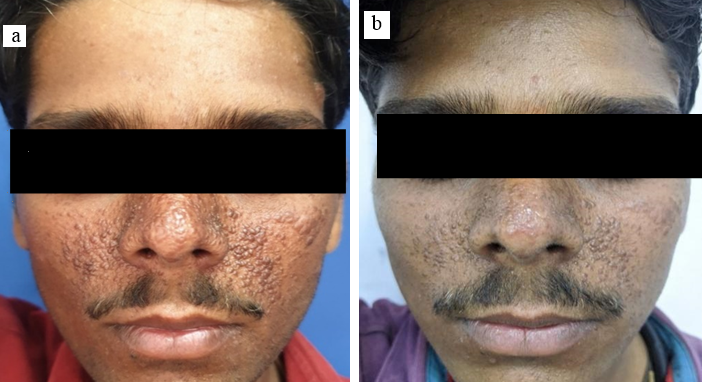a: Patient A before treatment; b: Patient A post-treatment