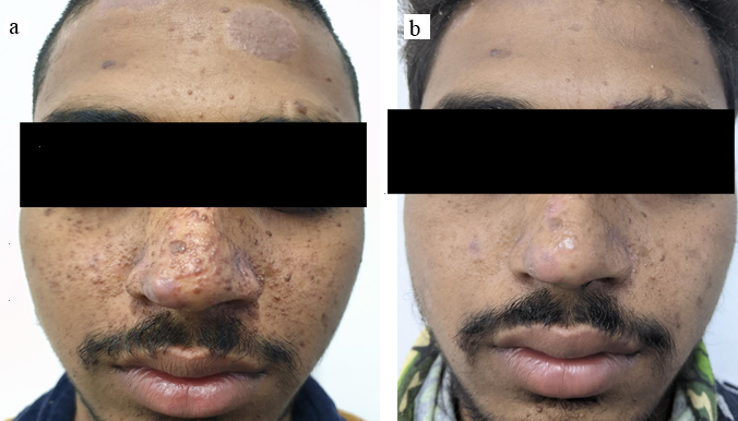 a: Patient B before treatment; b: Patient B post-treatment
