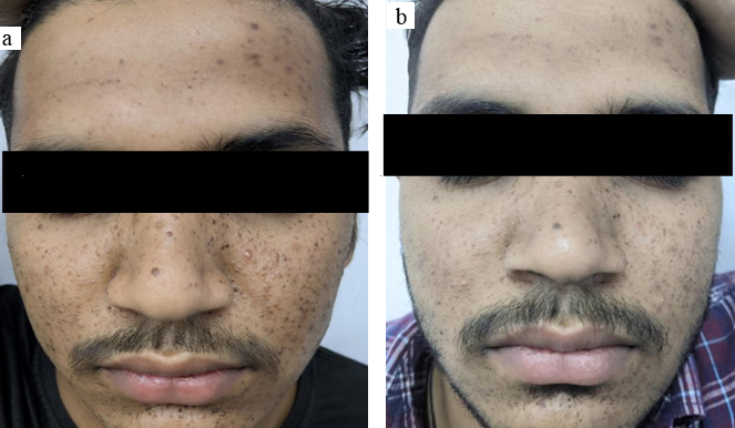 a: Patient C before treatment; b: Patient C post-treatment