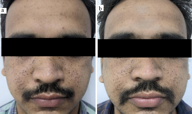a: Patient D before treatment; b: Patient D post-treatment