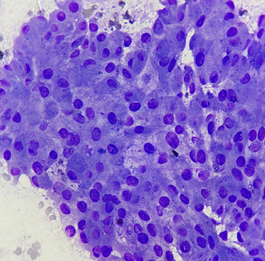 Fine needle aspiration cytology smear showing sheets of epithelial cells with enlarged nuclei and smooth nuclear contours. (Giemsa, x400)