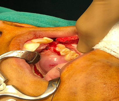 Intra operative picture of left hard palate