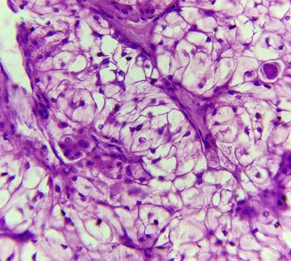 Histopathology of clear cell carcinoma of minor salivary gland (H & E, x400)