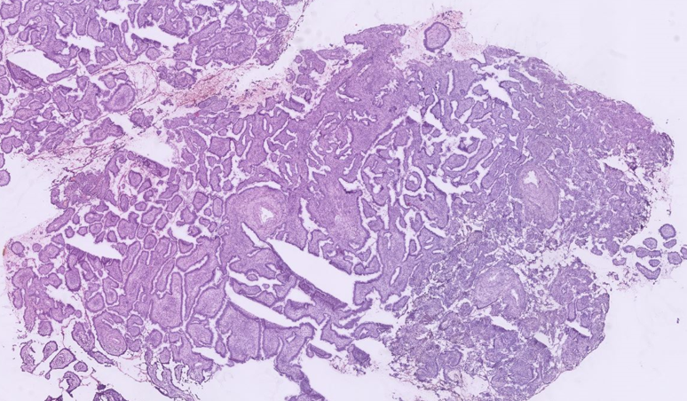 H&E 40x lesion with papillaroid pattern showing stratification and pleomorphism