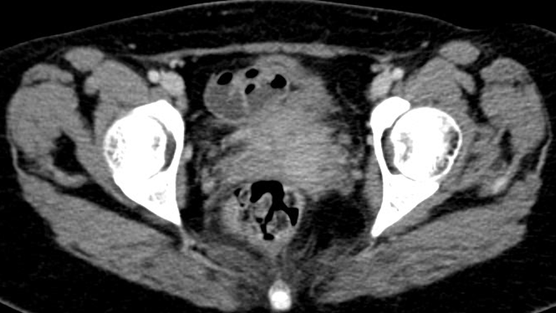 FDG PET scan showed 2x3.6cm poorly marginated cervical mass with minimal parametrial stranding
