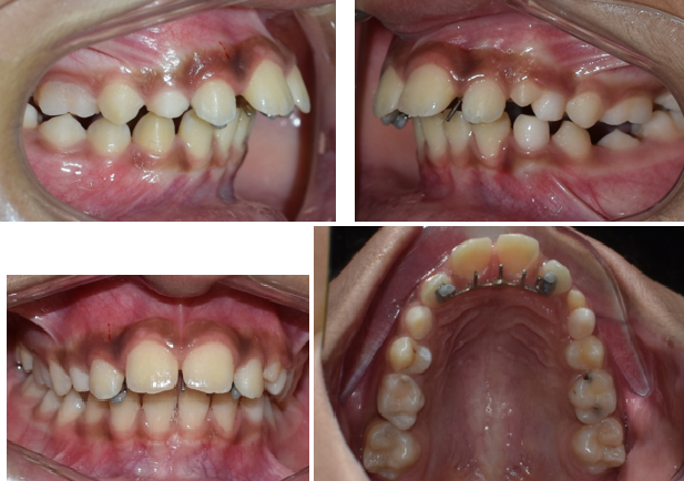 Intra-oral photographs