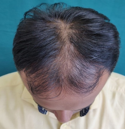 Ater 6 Sittingspatient showing moderate improvement in hair density