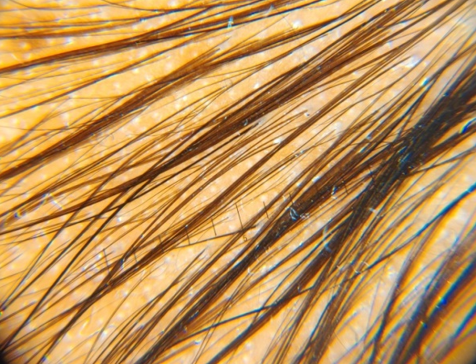 Ater 6 sittings patient showing a moderate improvement in hair density and shaft diameter.