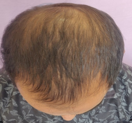 Ater 6 sittings patient showing a moderate improvement in hair density