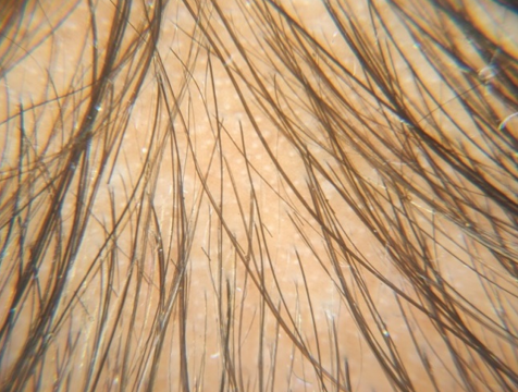 At baseline showing hair density and >20% variation in hair shaft diameter