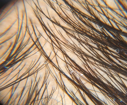 Ater 6 sittings patient showing a moderate improvement in hair density and hair shaft diameter