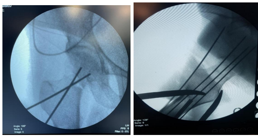 Anteroposterior and Lateral images of the guide wires. Two parallel guide wires placed just proximal to lesser trochanter superiorly and inferiorly at an angle equal to neck shaft angle of the opposite limb. Transverse guide wire placed perpendicularly to the fracture line from the greater trochanter passing centrally between the inferoanterior and inferoposterior guide wires