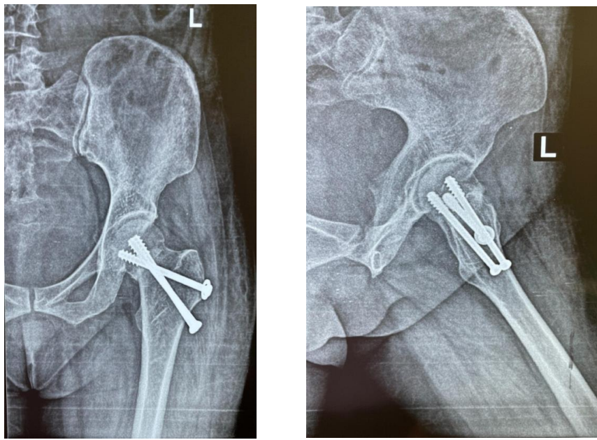 Postoperative anterior and lateral radiographs of the hip
