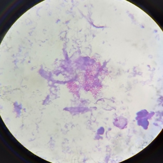 Direct Gram smear showing Gram negative coccobacilli