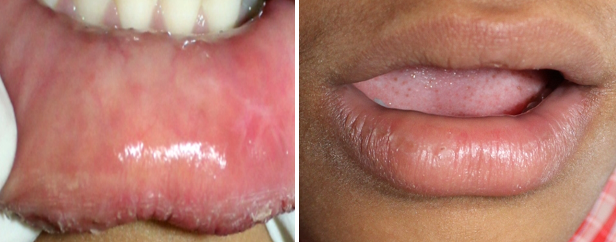 Intraoral examination showing complete healing after surgical excision with scar evident.(Case 1)