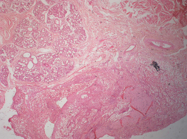 Histopathologic image showinggranulation tissue, inflammatory cell infiltrate, collagen fibres, blood vessel and the connective tissue stroma contains salivary gland acini. The submucosal shows presence of muscle fibres, adipocytes.(Case 1)