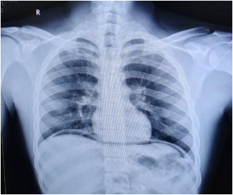 X-ray chest showing continuous diaphragm sign and free air under diaphragm