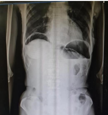 X-ray abdomen erect showing free air
