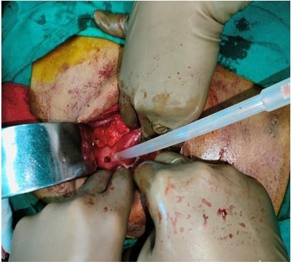 Intra op picture of Pre-pyloric perforation