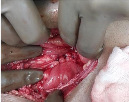 Intra oppicture of graham’s omental patch repair