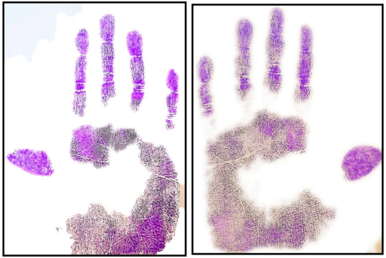 Dermatoglyphic patterns of both the palms recorded on the paper in cleft patients.