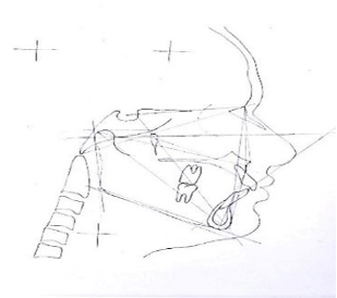 Manual tracing