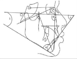 1.Angular Parameters FMA: Angle between Frankfort Horizontal plane and mandibular plane 2. SNA: Angle between Sella, Nasion and Point A 3. SNB: Angle between Sella, Nasion and Point B 4. ANB: Angle between Point A, Nasion and Point B 5. FMIA: Angle between Frankfort Horizontal plane and long axis of mandibular incisor 6. IMPA: Angle between mandibular plane and long axis of mandibular incisor 7. Facial axis: Angle between Basion- Nasion and Ptm to Gnathion 8. Facial angle: Angle between Nasion, Pogonion and FHP