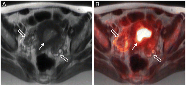 PET/MRI for systemic staging of intraorbital sarcoma in a 35-year-old woman with a history of Li-Fraumeni syndrome and multiple prior malignancies, including breast and thyroid cancers. Axial T2-weighted MR (A) and fused fluorine 18–fluorodeoxyglucose (FDG) PET/MR (B) pelvic images show marked FDG activity (solid arrow) in the endometrium, which has a thickened and abnormal appearance for the patient’s age at MRI. The distinction of benign versus malignant endometrial activity at PET/CT would not be possible in this patient. Follow-up pelvic US images (not shown) showed gradually decreasing endometrial thickening, which was believed to be due to ongoing tamoxifen use. In addition, the small amount of focal FDG activity in the right ovary (open arrows) would be difficult to differentiate from a lymph node at PET/CT.