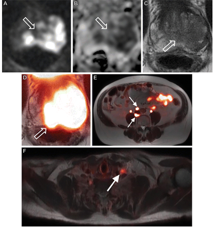 Initial staging 68Ga–PSMA-11 PET/MRI in a 65-year-old man with newly diagnosed Gleason 4 + 4 prostate cancer and pelvic adenopathy seen at staging prostate MRI. (A–D) Axial high–b-value diffusionweighted (A), apparent diffusion coefficient (B), T2-weighted MR (C), and fused PET/MR (D) images show a large intraprostatic tumor (arrow) occupying most of the left half of the gland. (E, F) Additional axial fused PET/MRI images show numerous subcentimeter metastatic lymph nodes (arrows) in the retroperitoneum and left supraclavicular fossa.