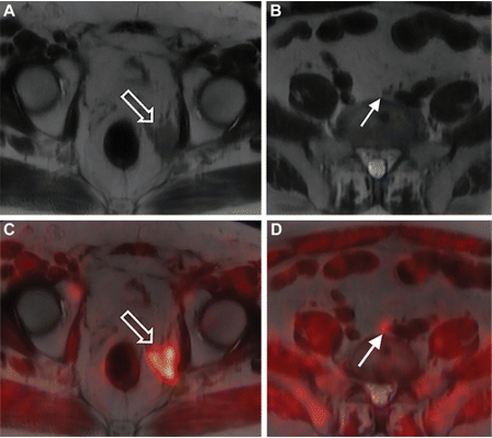 Fluciclovine PET/MRI in a 69-year-old man with elevated prostate-specific antigen levels (most recent, 2.1 ng/mL) who underwent prostatectomy for Gleason 4 + 3 prostate cancer 5 years earlier. Fluciclovine PET/MRI was performed to evaluate biochemical recurrence and for treatment planning. (A, B) Axial T2-weighted MR images show asymmetric T2-hypointense tissue (arrow in A) in the left prostatectomy bed and a subcentimeter left common iliac lymph node (arrow in B). (C, D) On the fused PET/ MR images, both lesions (arrow) demonstrate fluciclovine activity and are consistent with prostate cancer