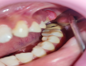 Preoperative