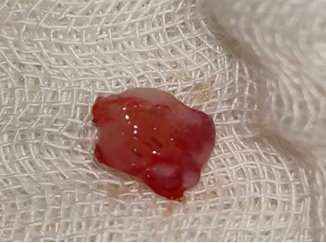 Excised tissue