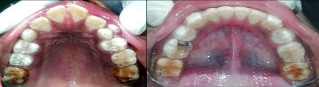 Intra oral view of upper and lower arch during first visit