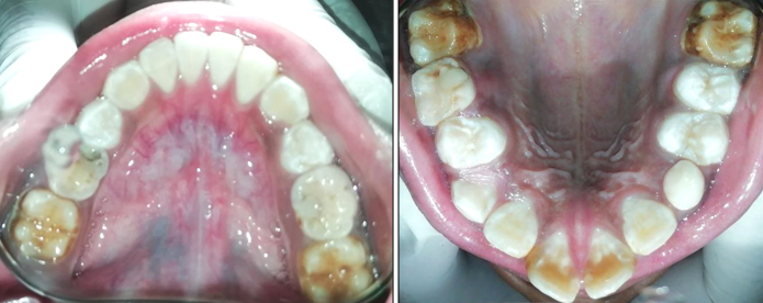 Intra Oral view of upper and lower arches after second appointment conducted after first month