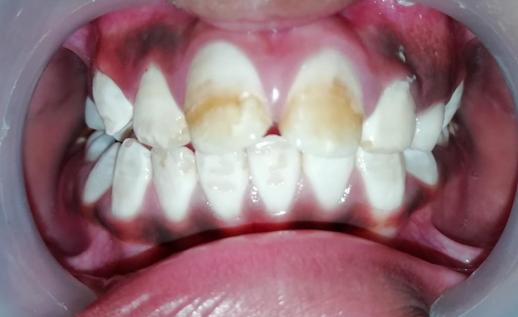 Intra Oral anterior view after second appointment conducted after first month