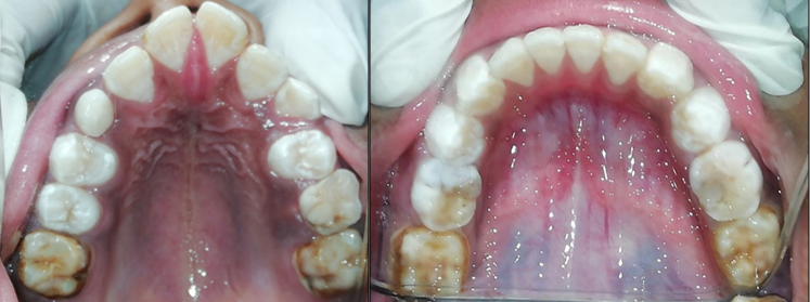 Intra oral view of upper and lower arches after third appointment conducted after the second month.