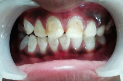 Intra oral anterior view after third appointment conducted after the second month.