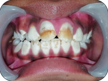 Intra oral anterior view