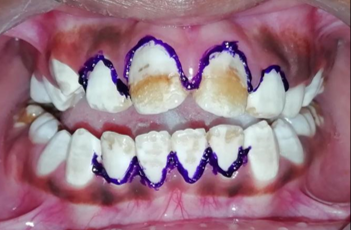 Application of gingival barrier to prevent gingival trauma or irritation