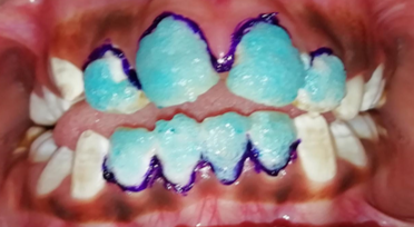 Etching the tooth surfaces with severe fluorosis