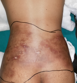 Preoperative posterior trunk