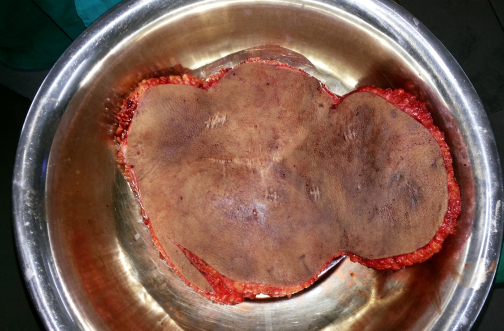 Intraoperative excised specimen
