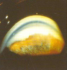 Gonioscopy picture of left: trabecular meshwork was visualised
