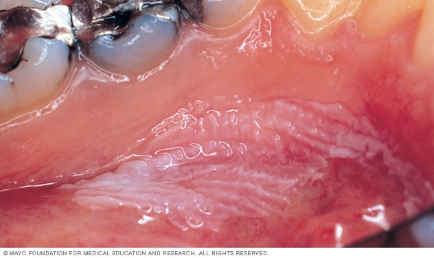 Leukoplakia, 