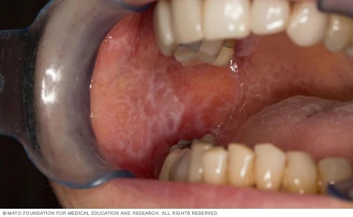 Oral lichen planus, 
