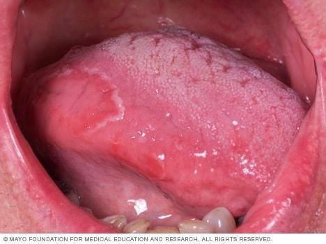 Geographic tongue, 